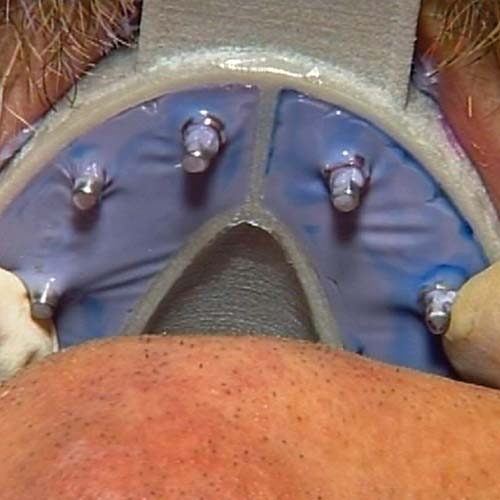 Hager MiraTray Implant Lower Small